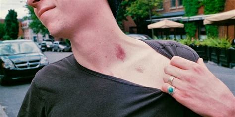 are hickeys dangerous|are hickeys cancerous.